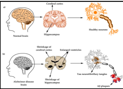 Healthy Brain - Preventing Neurological Decline - Brain Foundation