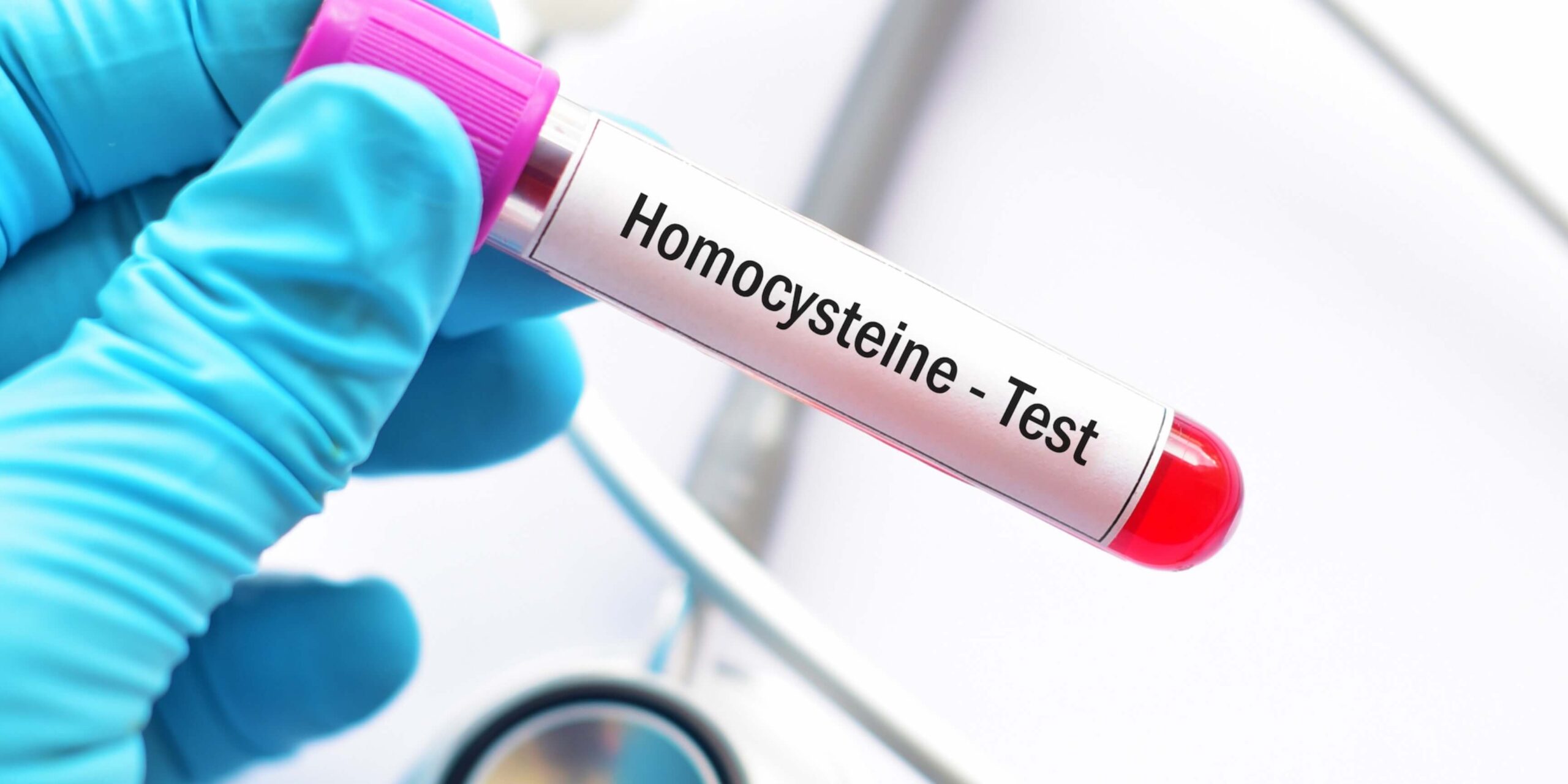 Homocysteine Testing